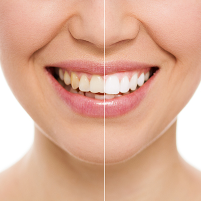 invención Esta llorando Víspera Teeth Whitening - Pine Ridge Dental Wellness